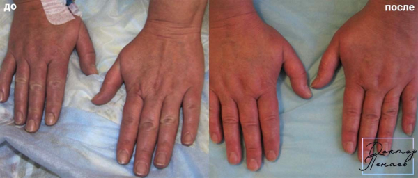 Пациентка профессора Пенаева до и после липофилинга кистей рук