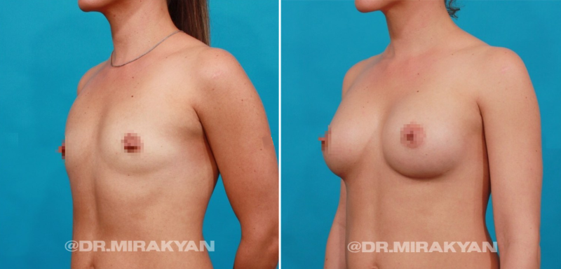 Пациентка пластического хирурга Гукаса Миракяна до и после увеличения груди