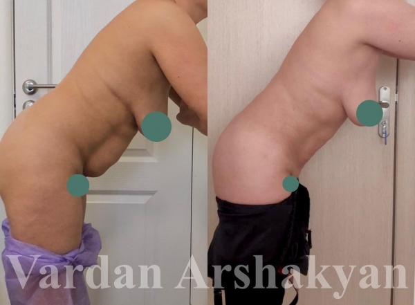 Пациентка доктора Аршакяна до и после радиочастотного скульптурирования туловища