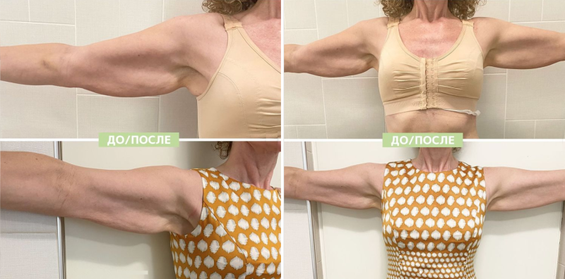 Пациентка клиники NBC до и после ультразвукового лифтинга ULFIT