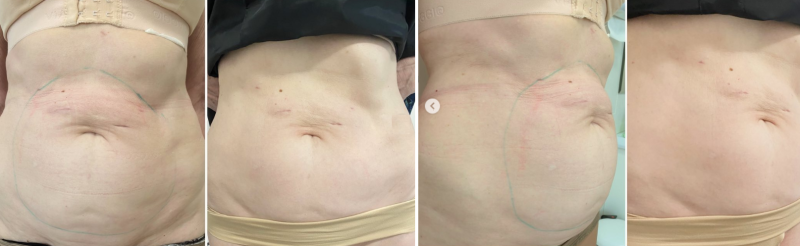 Пациентка клиники NBC до и после ультразвукового лифтинга ULFIT