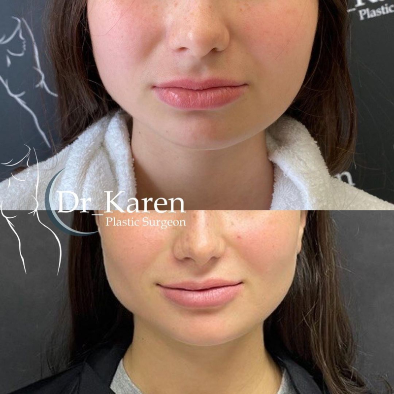 Пациентка хирурга Карена Пайтяна до и после V-Y-пластики верхней губ