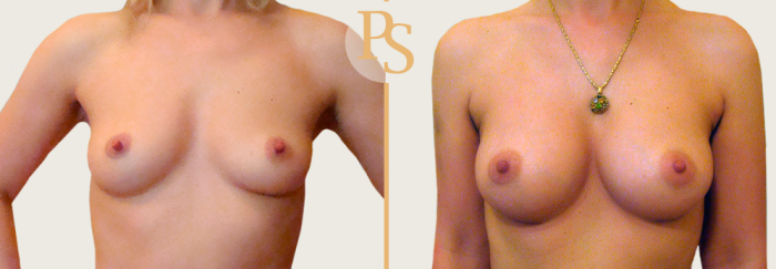 Пациентка С.Ю. Пшонкиной до и после увеличения груди анатомическими имплантами, объем 320 мл