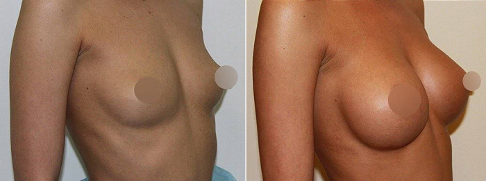 Пенаев увеличение груди