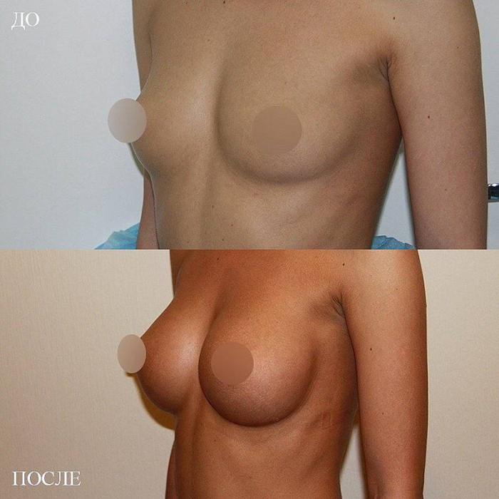Пациентка доктора Арслана Пенаева до и после увеличения груди
