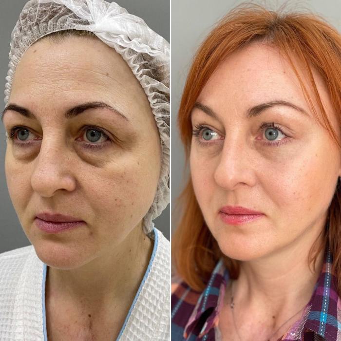 Пациентка пластического хирурга Марины Четвериковой до и после периорбитопластики.