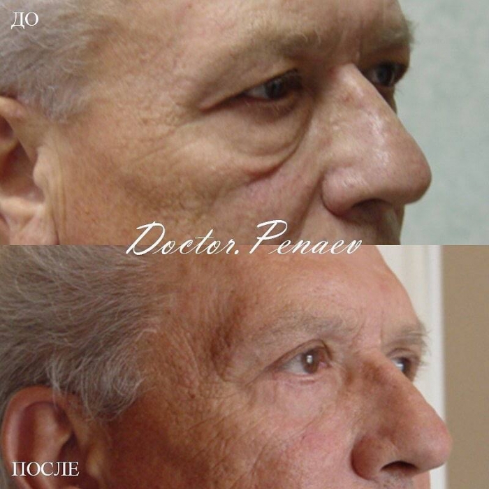 Пациент пластического хирурга Арслана Пенаева до и после блефаропластики