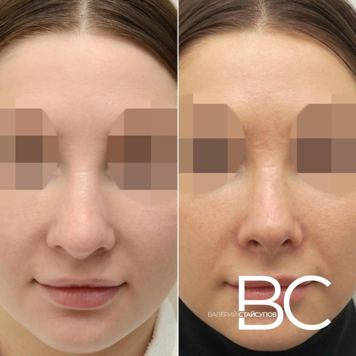 Пациентка пластического хирурга Валерия Стайсупова до и после закрытой ринопластики
