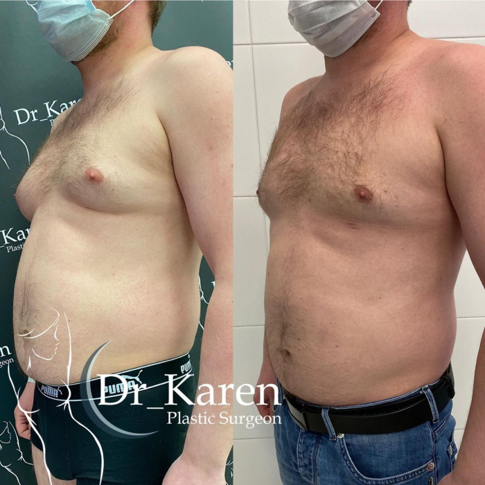 Пациент пластического хирурга Карена Пайтяна до и после гинекомастии