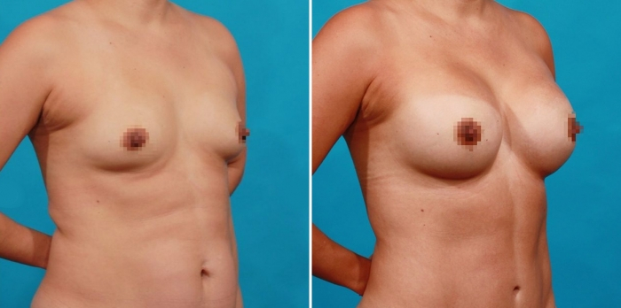 Пациентка доктора Гукаса Миракяна до и после увеличения груди