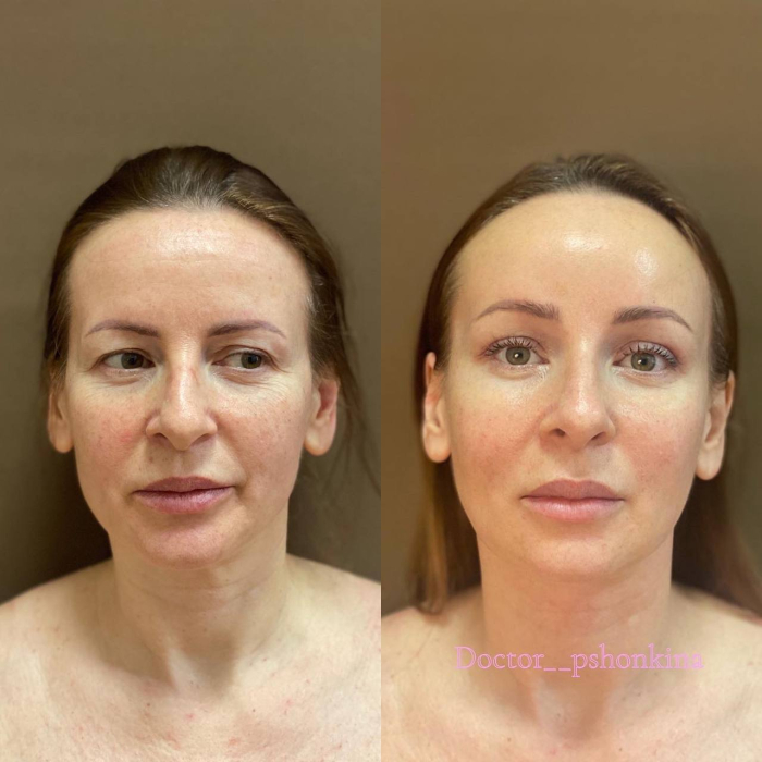 Пациентка пластического хирурга Светланы Пшонкиной. Фото до и после омоложения лица. Для достижения желаемого эстетического результата были выполнены малоинвазивные методики —эндоскопическая подтяжка, Face Tite  и процедура Fractora