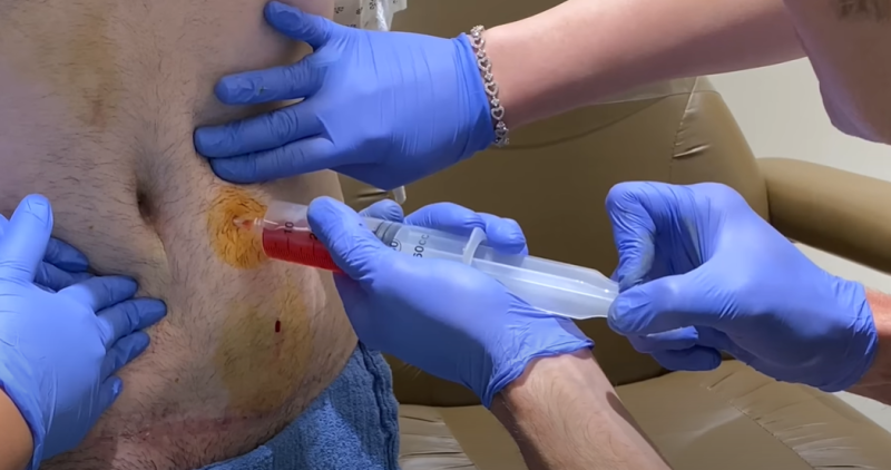 Лечение серомы