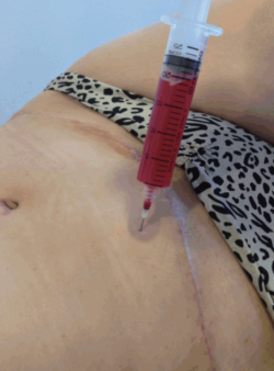 Серома после подтяжки живота и ее лечение