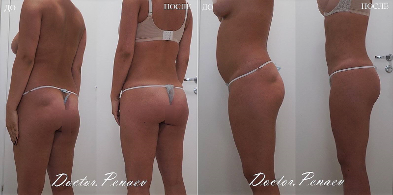 Пациентка пластического хирурга Арслана Пенаева до и после операции Боди-дизайн