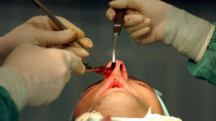 Ринопластика полностью индивидуализирована