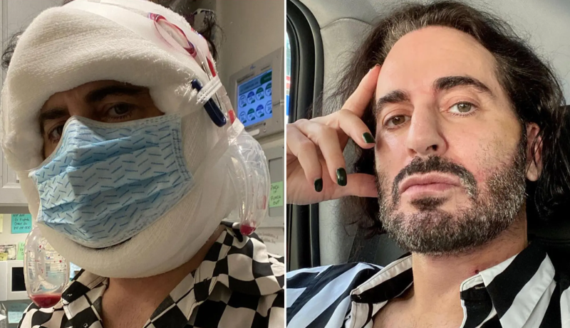 Дизайнер Марк Джейкобс публиковал селфи после своей омолаживающей пластической операции