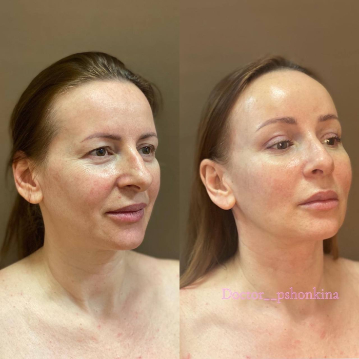 Пациентка пластического хирурга Светланы Пшонкиной. Фото до и после омоложения лица. Для достижения желаемого эстетического результата были выполнены малоинвазивные методики —эндоскопическая подтяжка, Face Tite  и процедура Fractora