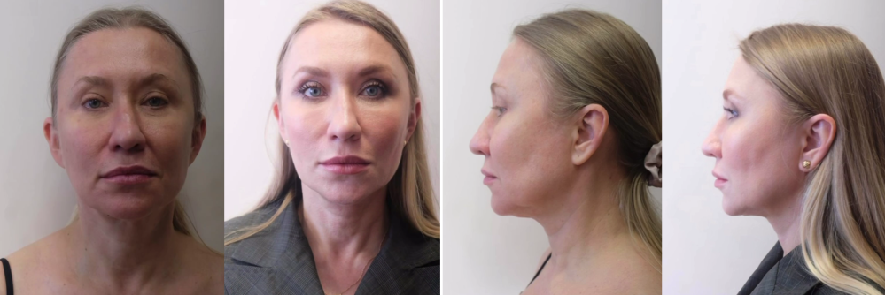 Пациентка пластического хирурга Светланы Пшонкиной. Фото до и после омоложения лица. Женщине была проведена нитевая подтяжка, ФейсТайт подбородка и радиочастотный лифтинг Fractora