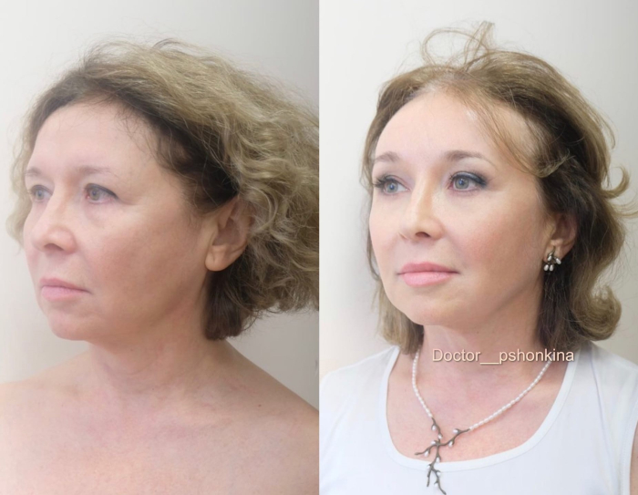 Пациентка пластического хирурга Светланы Пшонкиной. Фото до и после омоложения лица. Женщине была проведена эндоскопическая подтяжка и радиочастотный лифтинг Fractora