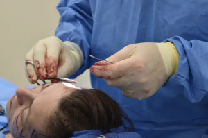 Некроз кожи после хирургической подтяжки лица