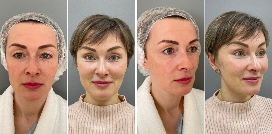 Пациентка пластического хирурга Марины Четвериковой до и после эндоскопического омоложения лица.