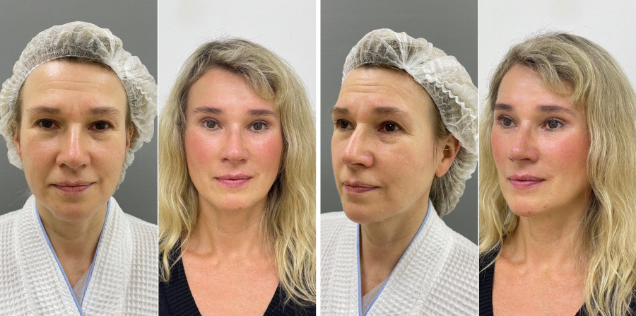  Пациентка пластического хирурга Марины Четвериковой до и после комплексного эндоскопического омоложения лица в Санкт-Петербурге