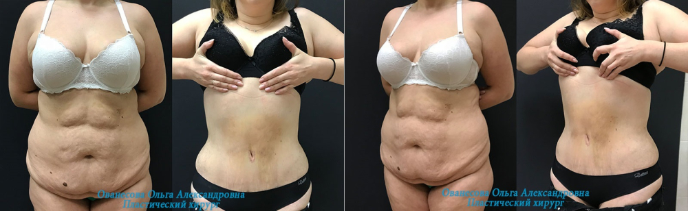 Пациентка пластического хирурга Ольги Ованесовой до и после абдоминопластики