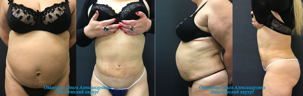 Пациентка пластического хирурга Ольги Ованесовой до и после абдоминопластики