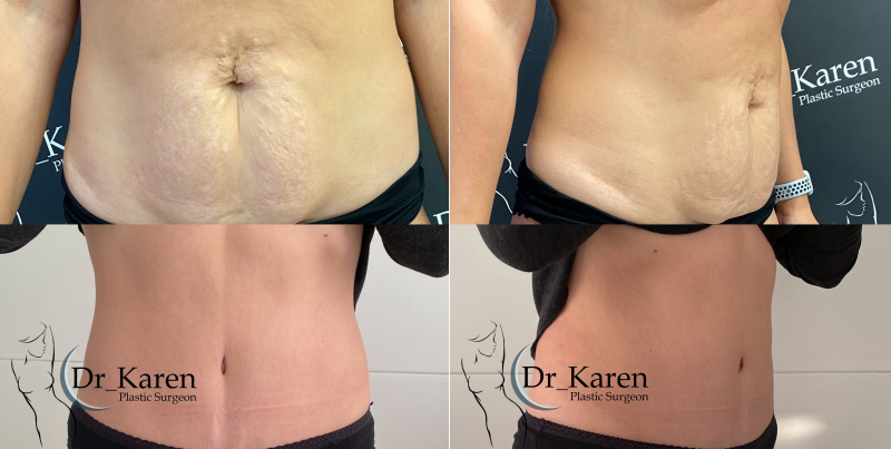 Пациентка пластического хирурга Карена Пайтяна до и после абдоминопластики.