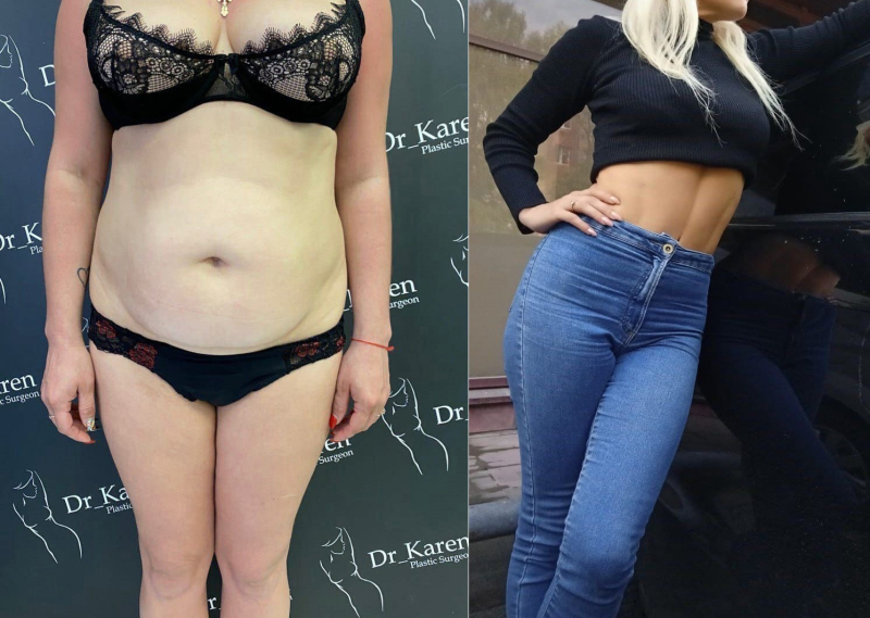 Пациентка пластического хирурга Карена Пайтяна до и после абдоминопластики с липосакцией