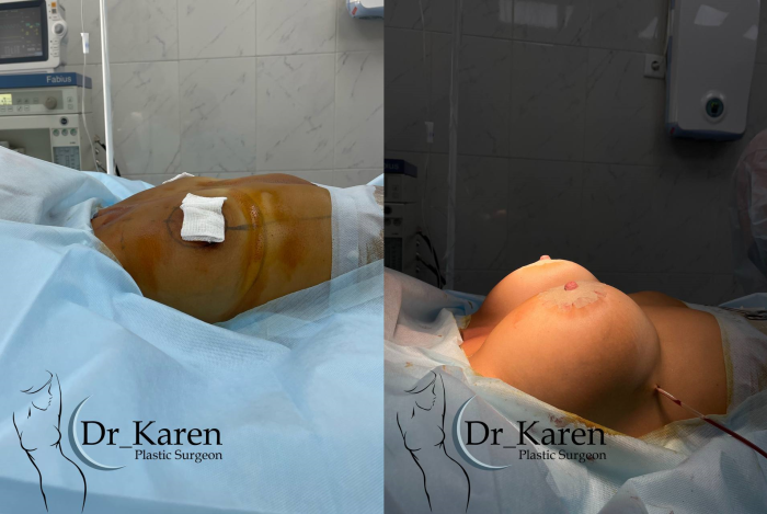 Пациентка пластического хирурга Карена Пайтяна. На фото результат увеличения груди с подтяжкой вокруг ареол (сразу после операции)