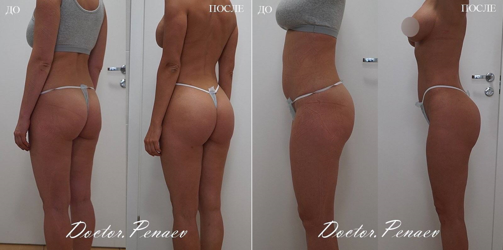 Пациентке выполнена мультизональная VASER-липосакция с липотрансфером ягодиц.