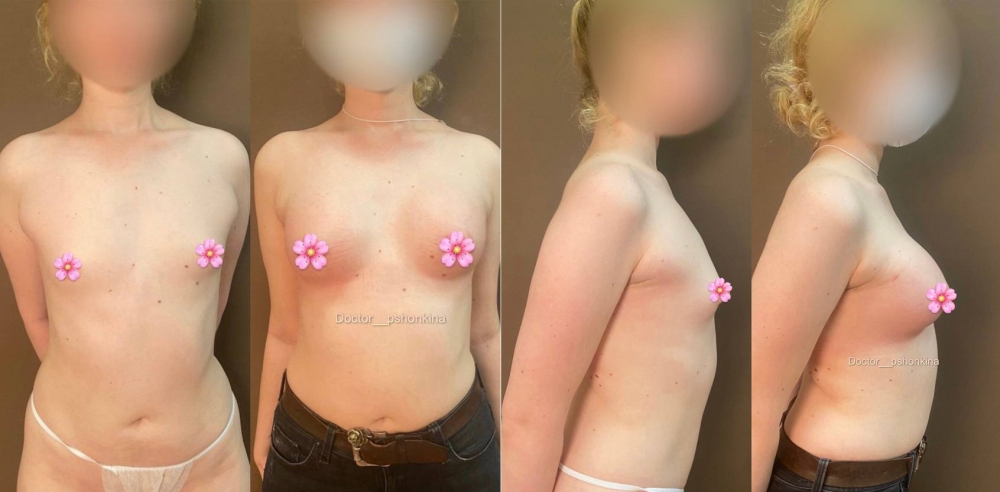 Пациентка пластического хирурга Светланы Пшонкиной до и после увеличения груди имплантами