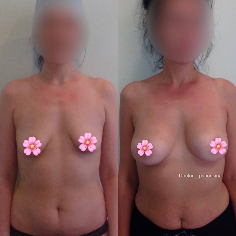 Пациентка пластического хирурга Светланы Пшонкиной до и после одновременного увеличения груди имплантами и подтяжки.