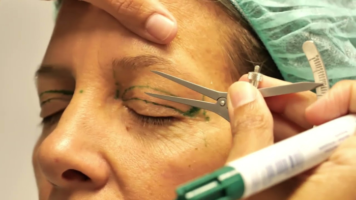 5 вещей, которые нужно знать о блефаропластике