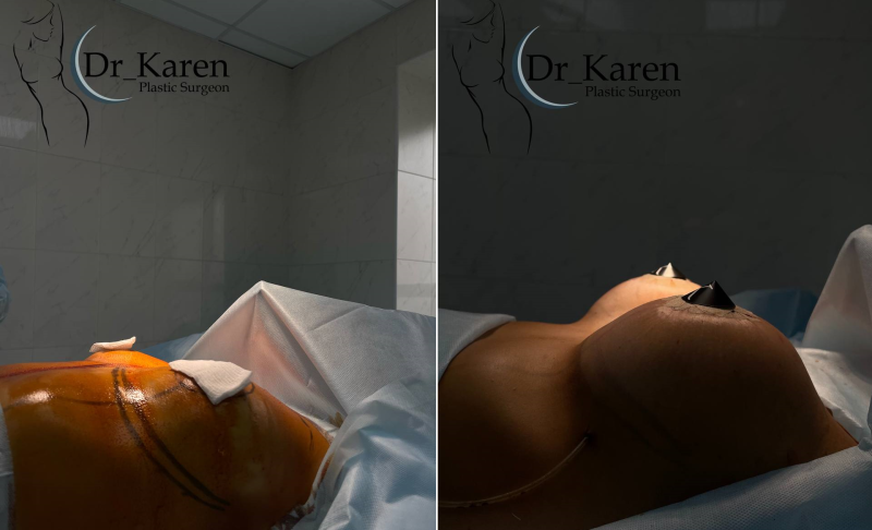 Пациентка пластического хирурга Карена Пайтяна. На фото — результат увеличения груди с подтяжкой вокруг ареол.