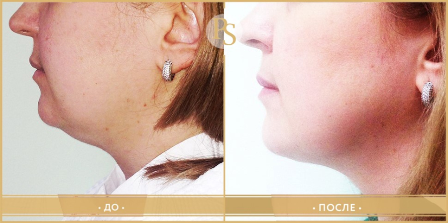 Пациентка пластического хирурга Светланы Пшонкиной. Фото до и после радиочастотного лифтинга.