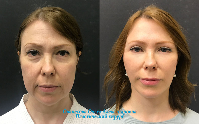 Пациентка пластического хирурга Ольги Ованесовой до и после комплексного омоложения лица и шеи
