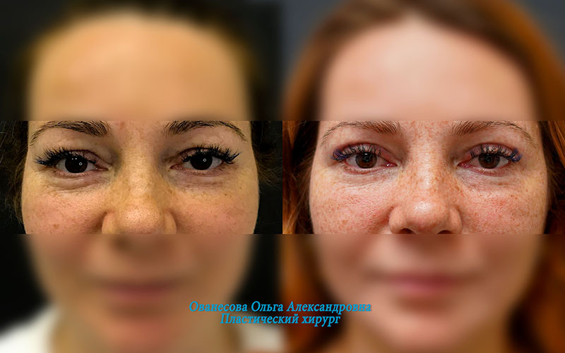 Пациентка доктора Ольги Ованесовой до и после блефаропластики