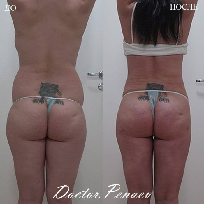 Пациентка до и после вазер-липосакции и липофилинга ягодиц