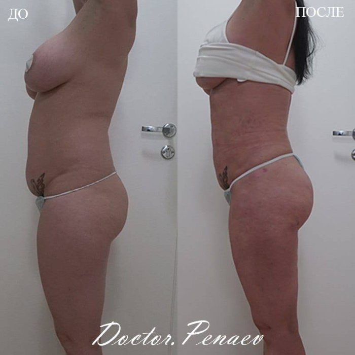Пациентка до и после вазер-липосакции и липофилинга ягодиц в Москве