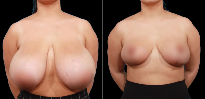  Пациентка пластического хирурга Гукаса Миракяна до и после уменьшающей маммопластики