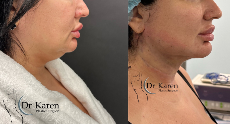 Пациентка пластического хирурга Карена Пайтяна до и после липомоделирования подбородка