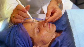 Подтяжка лица