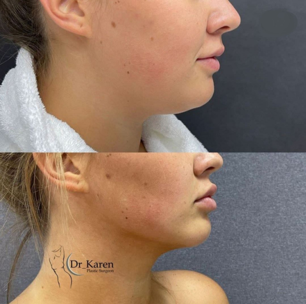 Пациентка пластического хирурга Пайтяна К.Г. до и после удаления комков Биша и липомоделирования подбородка