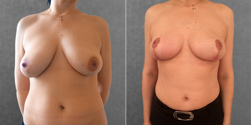 Фото пациентки доктора Дмитрия Крысина до и после подтяжки груди (мастопексии).
