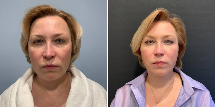 Александр Леонидович Катков спейслифтинг