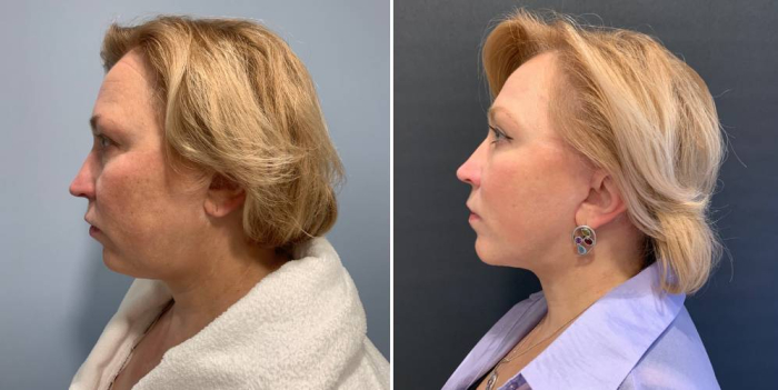 Александр Леонидович Катков спейслифтинг