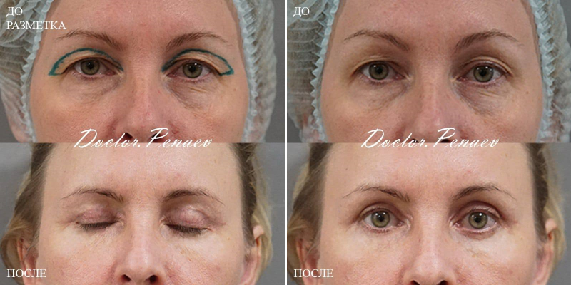 Фото пациентки до и после блефаропластики