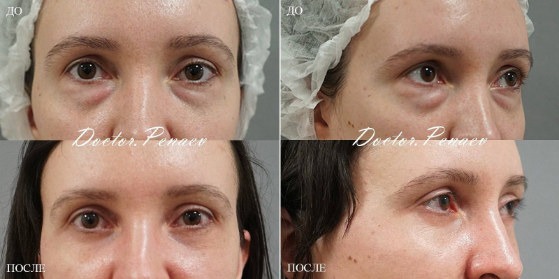 Фото до и после трансконъюнктивальной блефаропластики